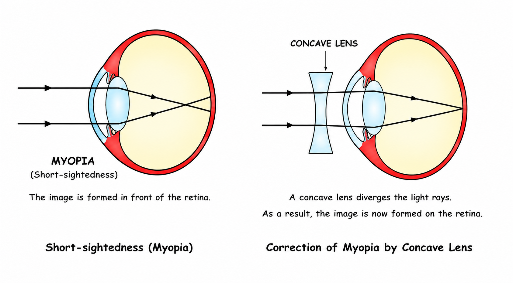 Fig 9.15: Short-sightedness (Myopia) and its correction